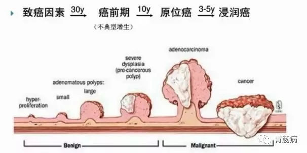 體檢查出腸息肉一定要切除！ 95%腸癌由它演變而來(lái)