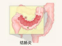 南寧治療結(jié)腸炎哪家醫(yī)院