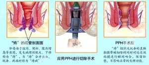 南寧肛腸醫(yī)院 南寧醫(yī)博中醫(yī)肛腸醫(yī)院 南寧看痔瘡的醫(yī)院 南寧肛瘺醫(yī)院 南寧肛裂醫(yī)院 南寧腸炎醫(yī)院