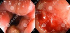 做無(wú)痛腸鏡需要多少錢