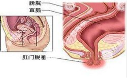 南寧治療脫肛哪家醫(yī)院好？南寧脫肛治療多少錢(qián)？